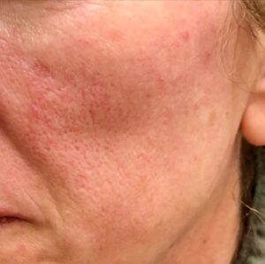 Understanding Broken Capillaries on the Face: Causes, Appearance, and Laser Treatment