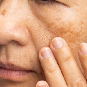 Everything You Need to Know About Hyperpigmentation